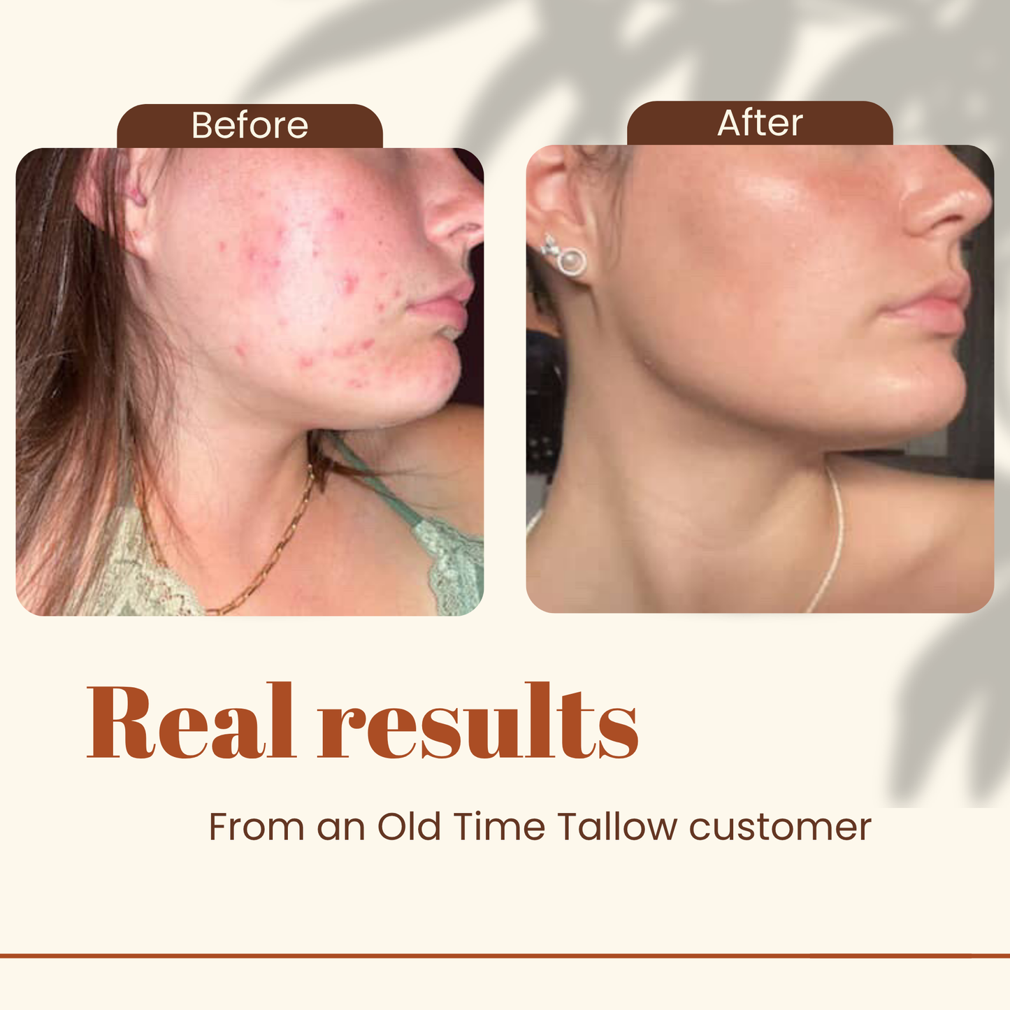 Before and after photos of a women’s acne-prone skin showing clear improvement after using Old Time Tallow moisturizer
